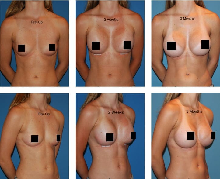 Breast Augmentation Surgery 52