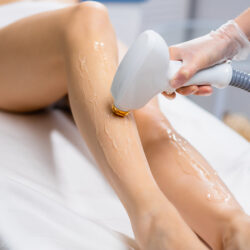 Laser Hair Removal: Chicago Laser Procedures
