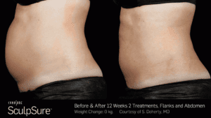 A woman's stomach before and after a tummy tuck.