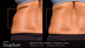 A before and after photo of a tummy tuck treatment.