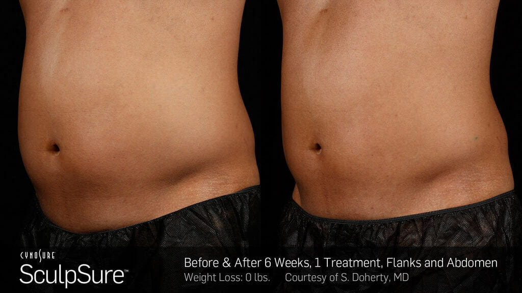 A before and after photo of a Sculpsure treatment of male flanks and abdomen after 6 weeks.