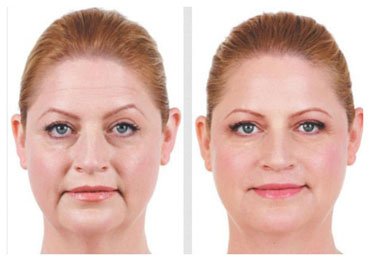 Dr Rachel Juvederm before and after