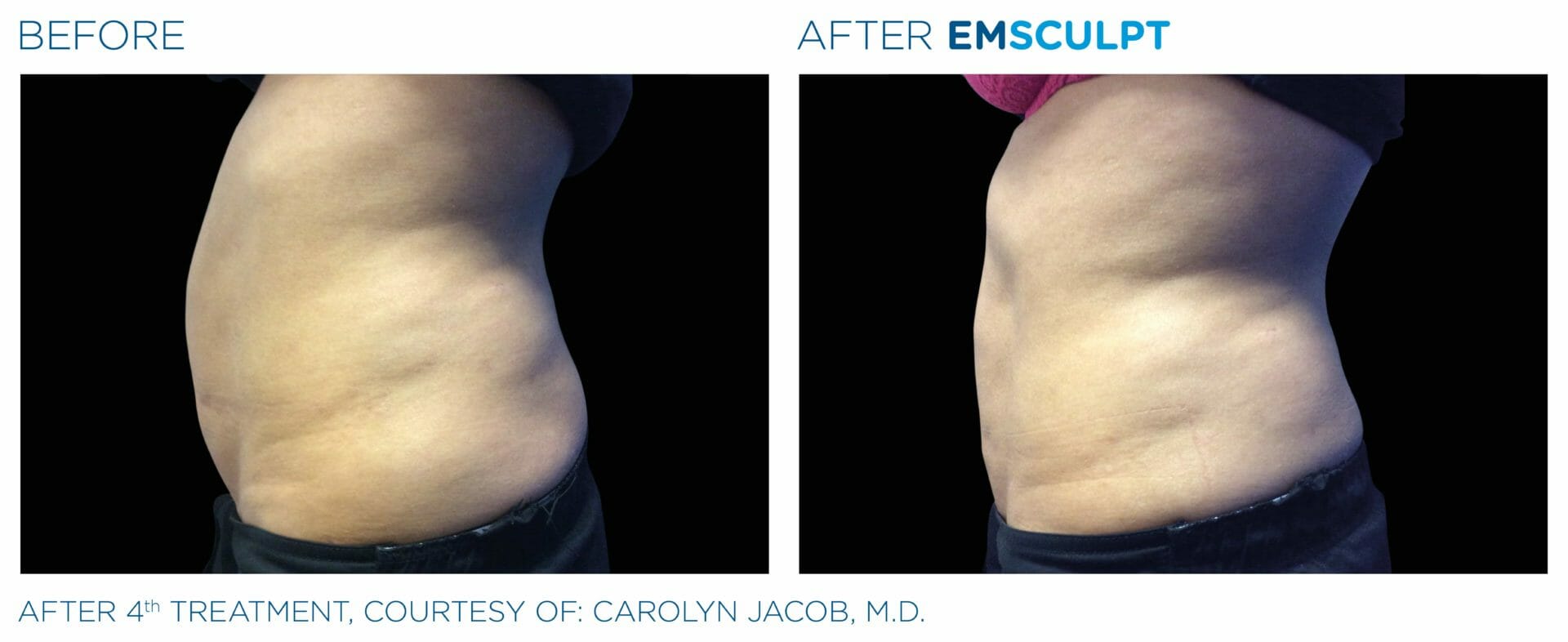 emsculpt before after photo chicago