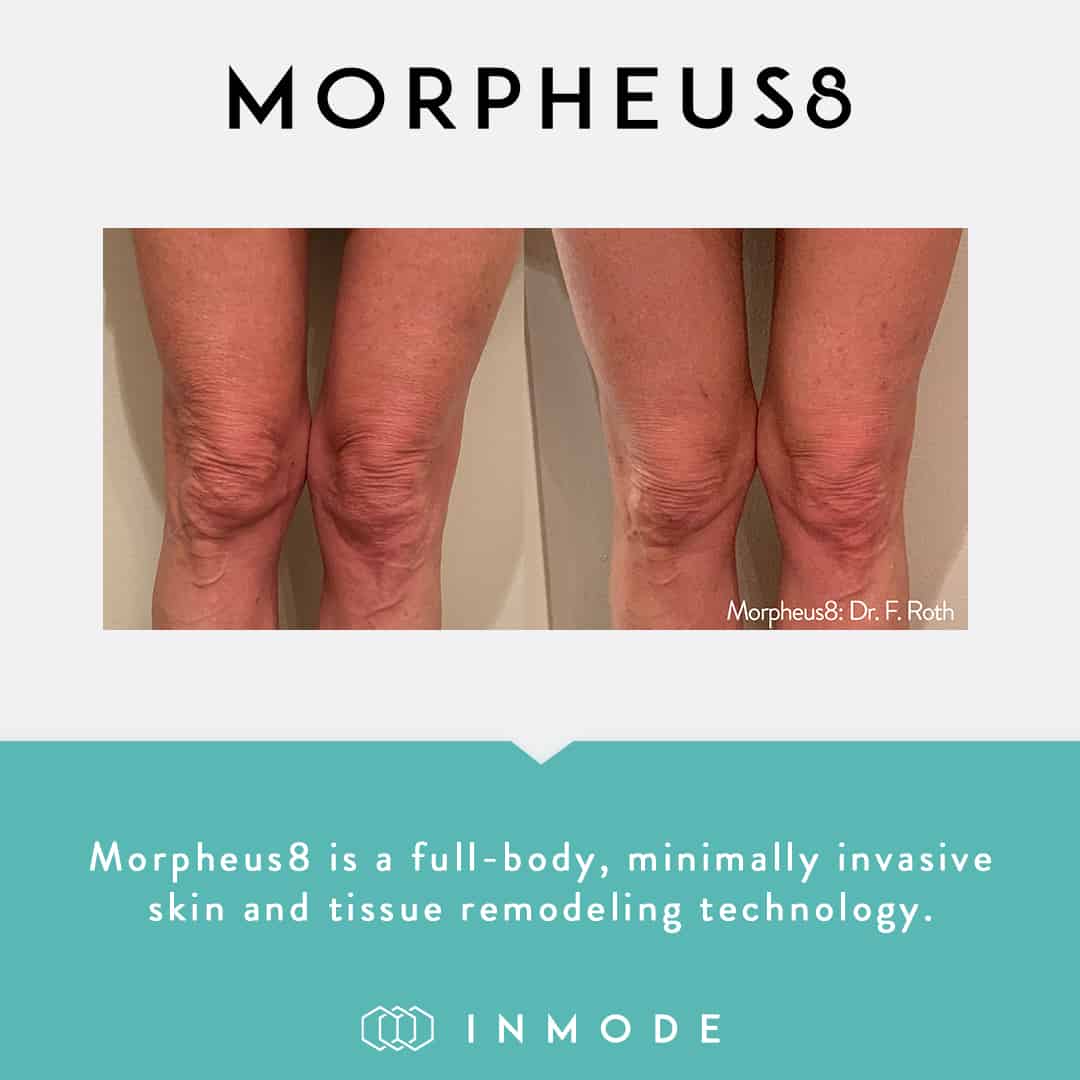 morpheus8 before after legs