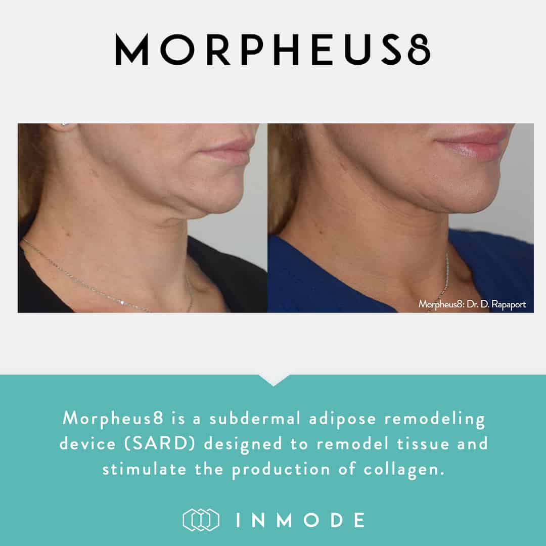 morpheus8 before after neck and jaw