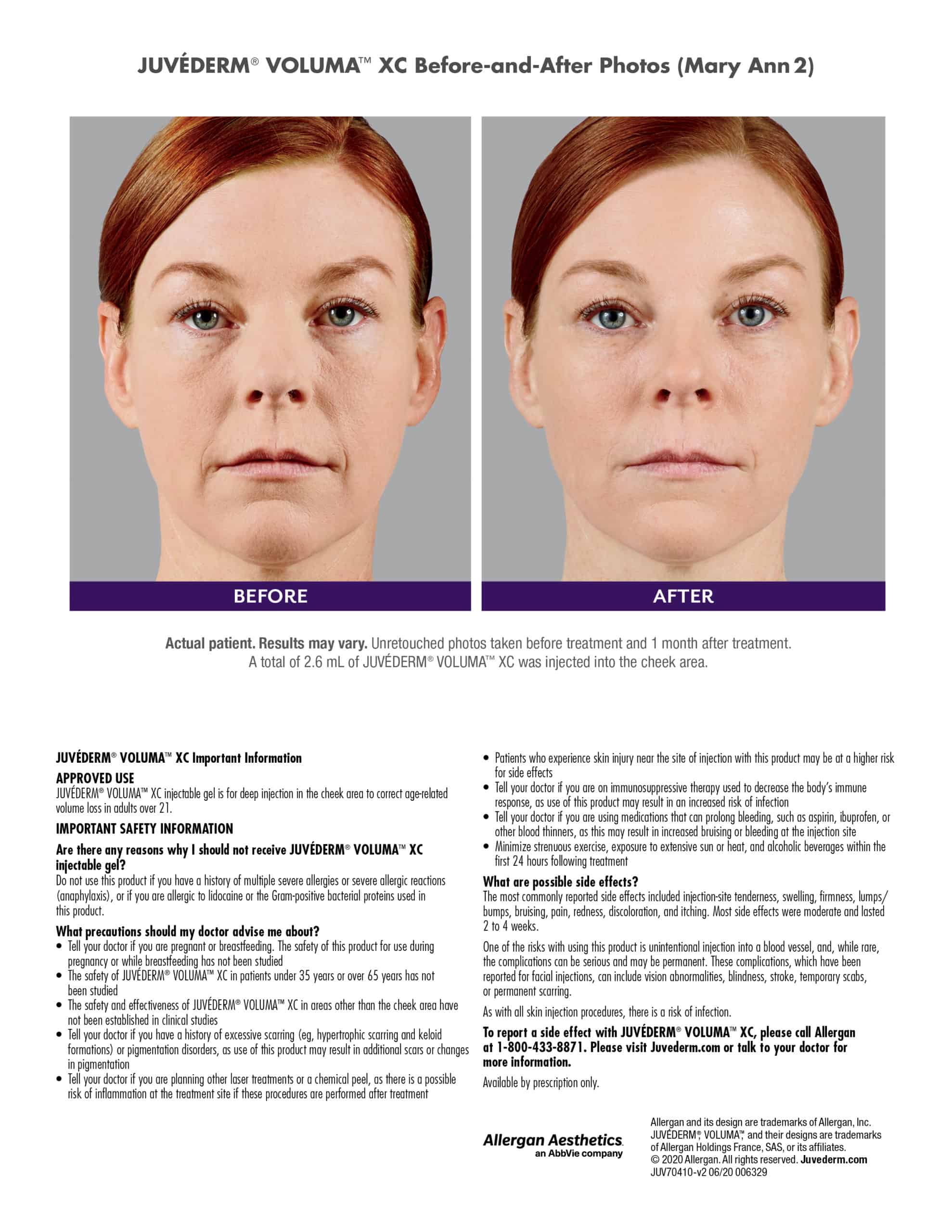 juvederm ultra before after chicago aesthetics