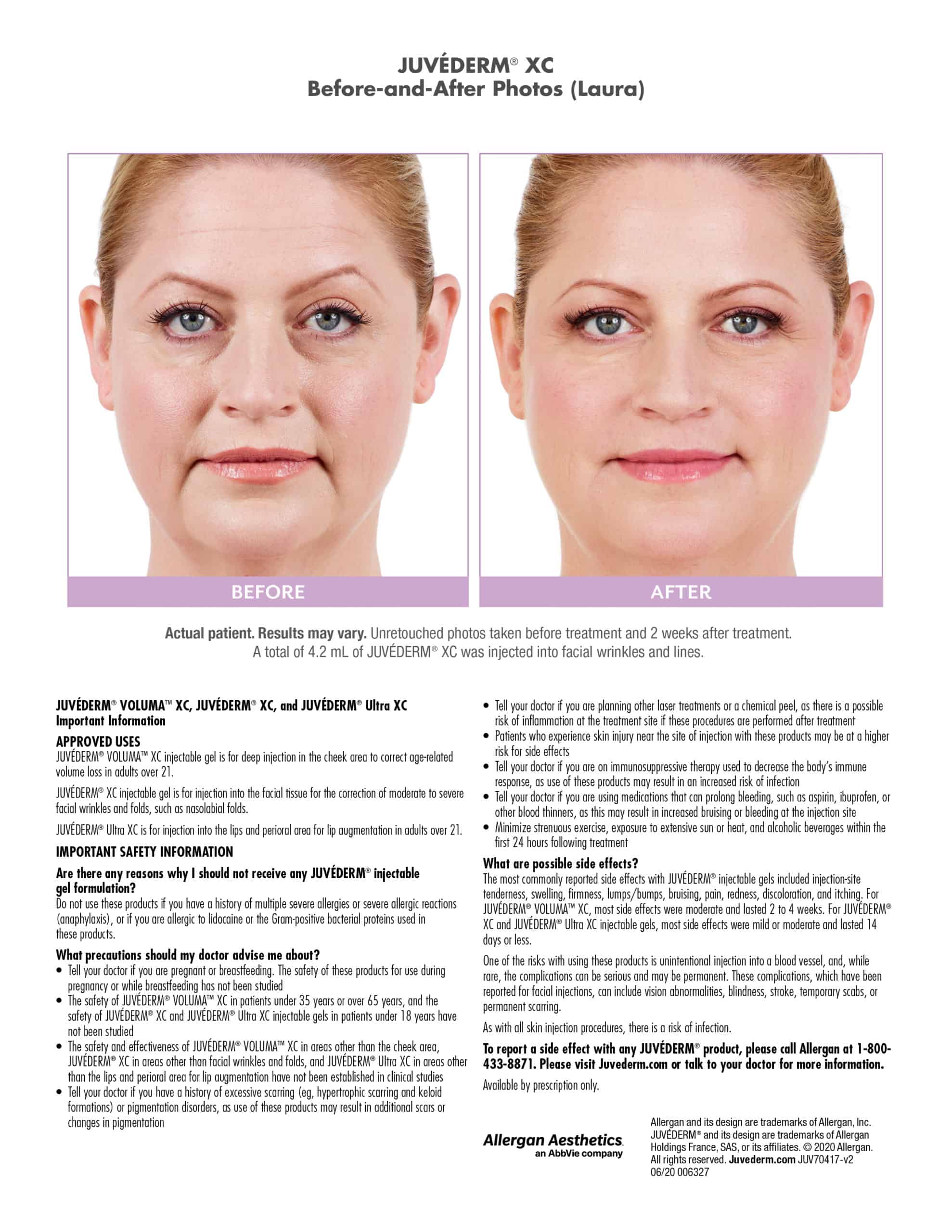 Juvederm XC before after photo Chicago Aesthetics