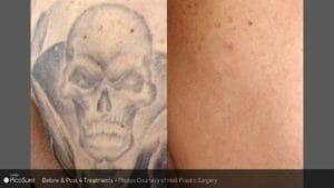 laser tattoo removal before after