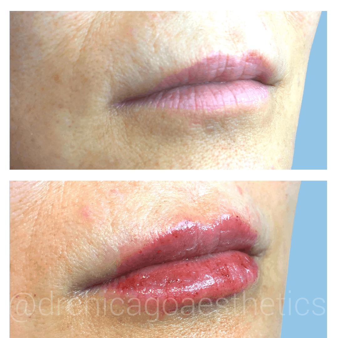 Juvederm before after lip injections Chicago Aesthetics