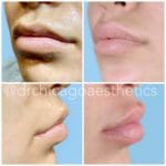 lip augmentation before after by chicago aesthetics