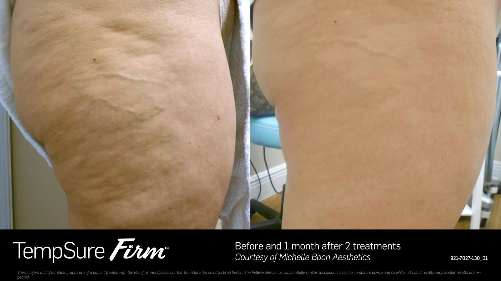 cellulite tempsure firm before after photo