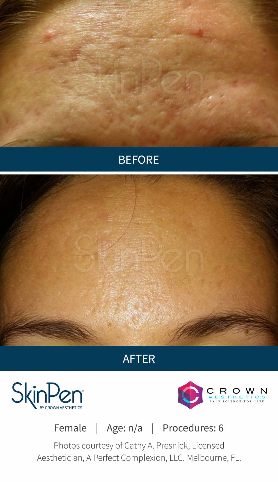 Before-After-Microneedling-Skinpen-Chicago (3)