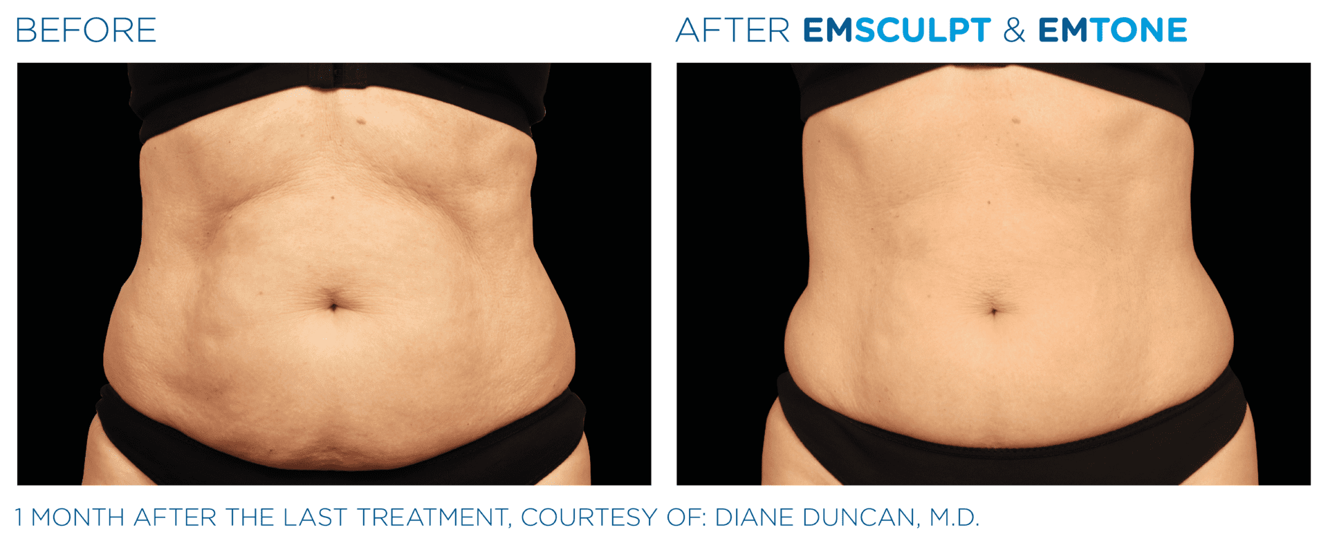 emsculpt abs before after Chicago Aesthetics