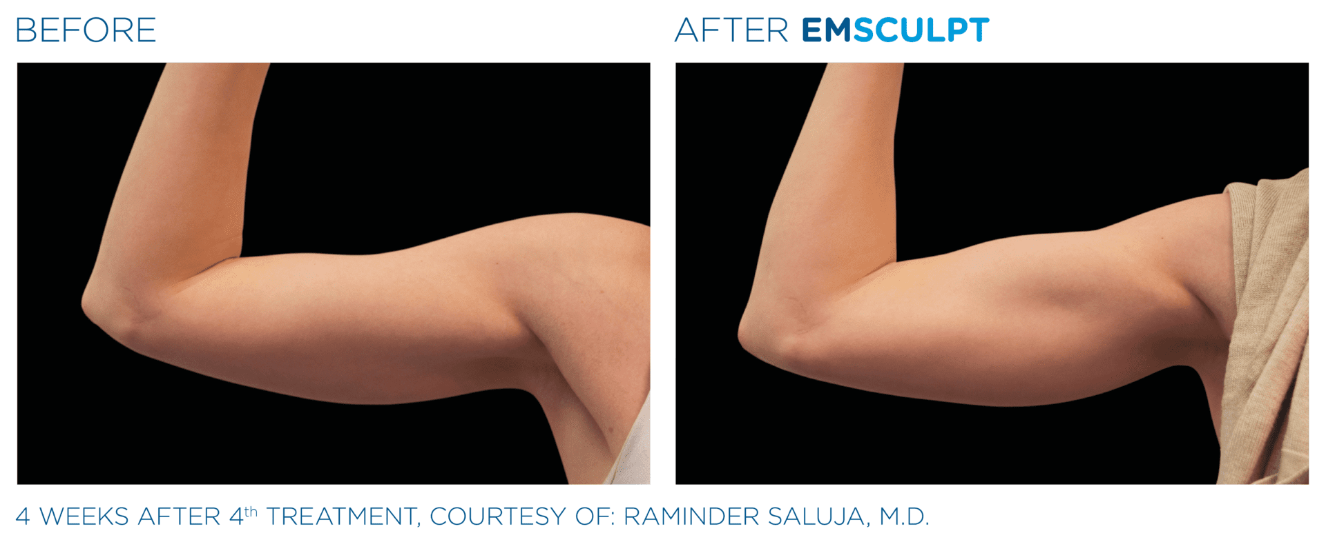 emsculpt arms before after