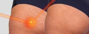 Laser Stretch Mark Treatment | Chicago Aesthetic Surgery &Amp; Med Spa