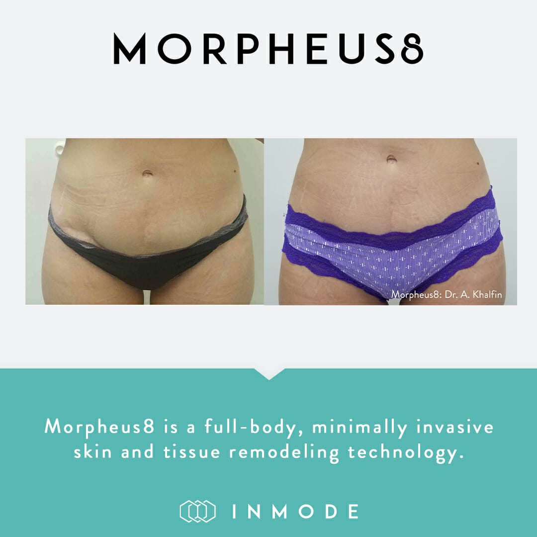 morpheus8 before after stomach