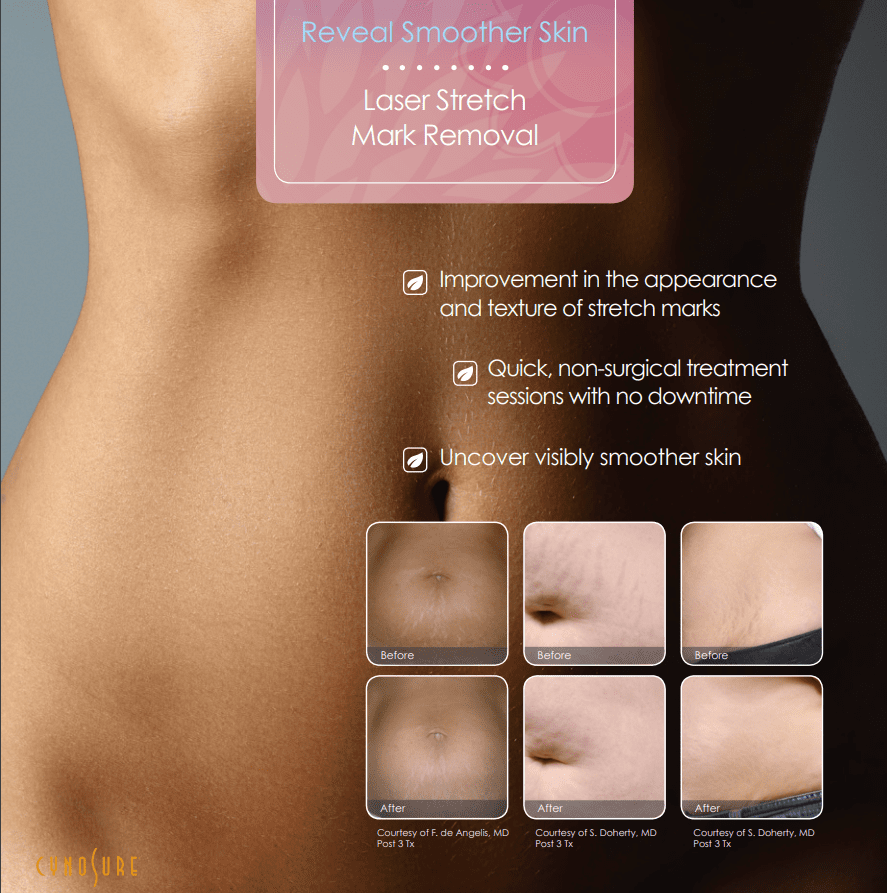 how much does laser stretch mark removal cost