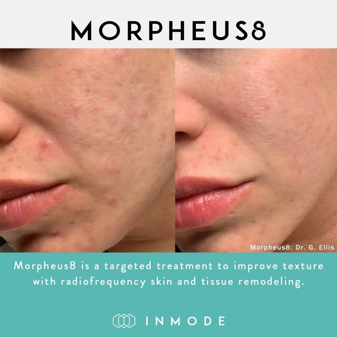 acne treatment morpheus8