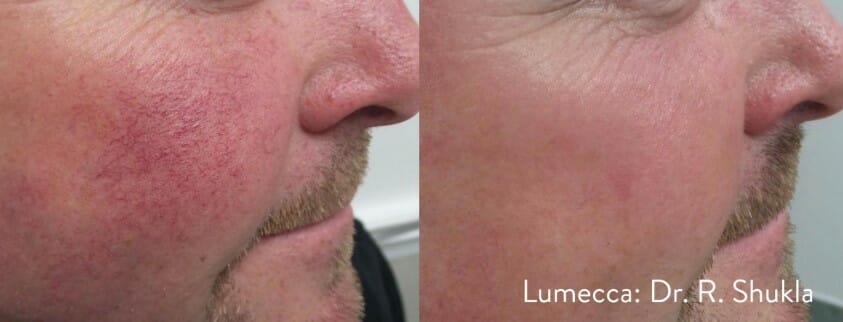 IPL-photofacial-before-after-lumecca-chicago (11)