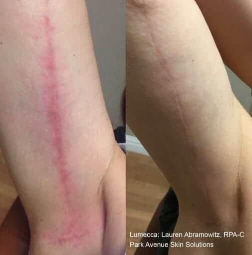 IPL-photofacial-before-after-lumecca-chicago (15)