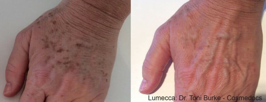 IPL-photofacial-before-after-lumecca-chicago (17)