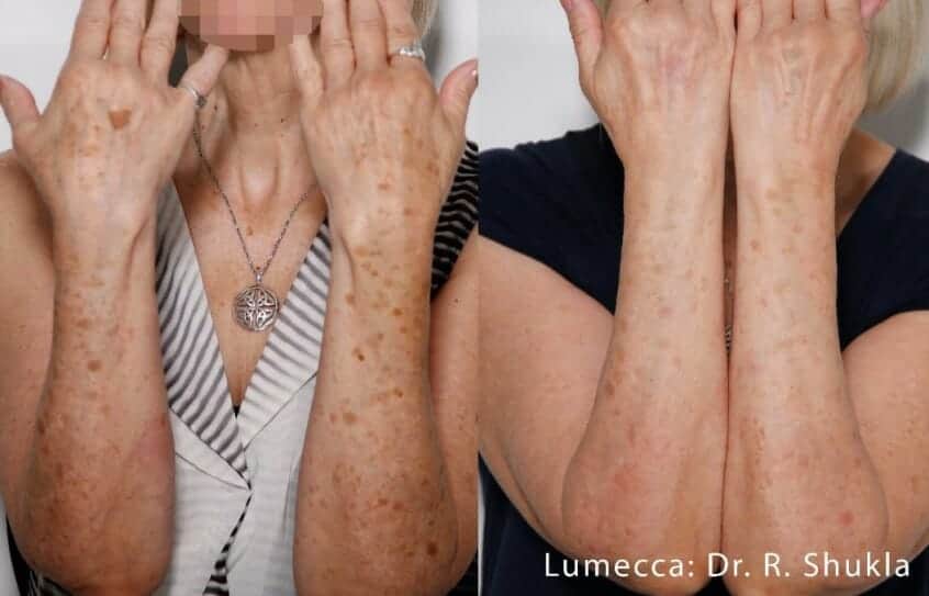 IPL-photofacial-before-after-lumecca-chicago (18)