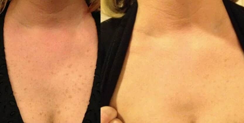 IPL-photofacial-before-after-lumecca-chicago (19)