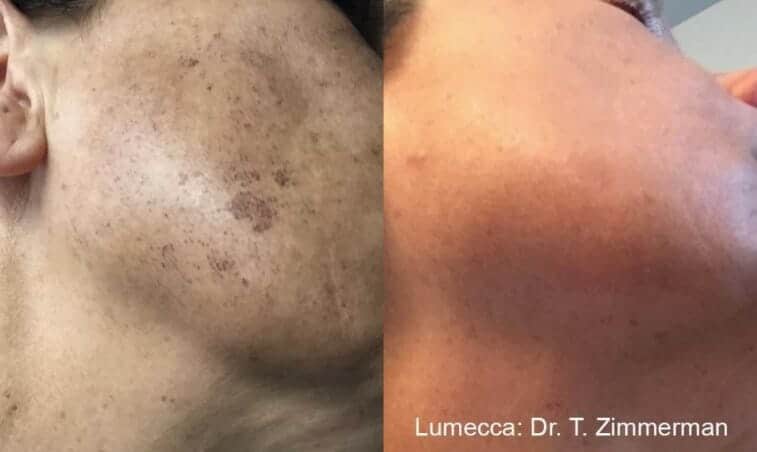 IPL-photofacial-before-after-lumecca-chicago (5)