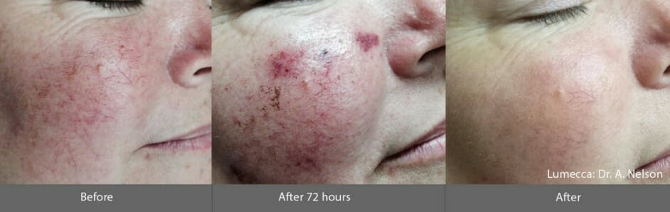 IPL-photofacial-before-after-lumecca-chicago (9)