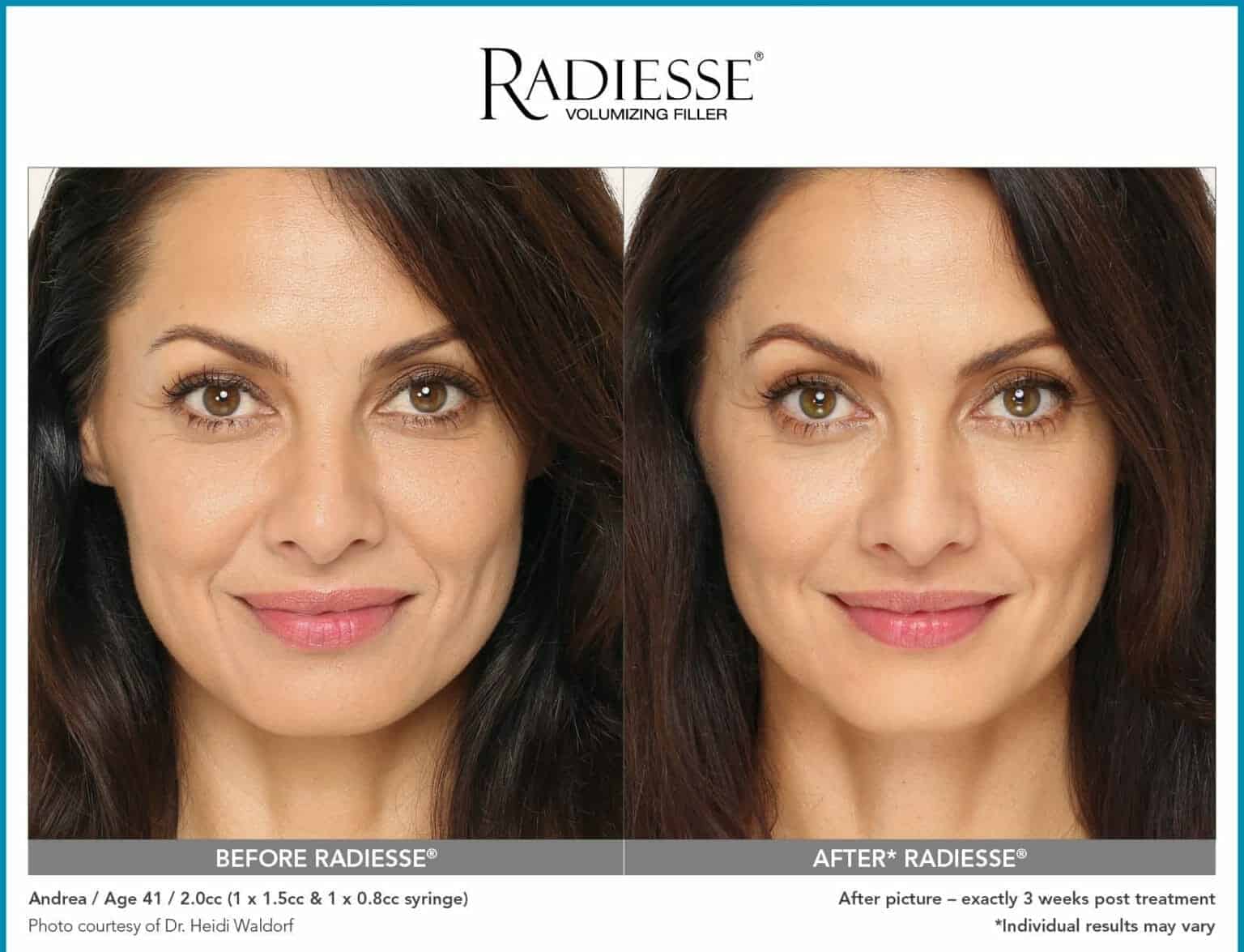Radiesse filler near me