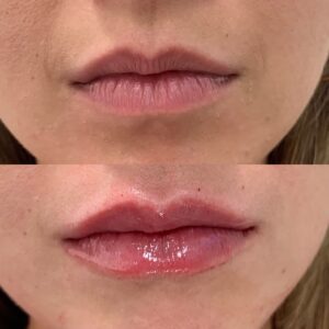 Michael-Sheehan-Chicago-Aesthetics-Injector-Lip-Injections