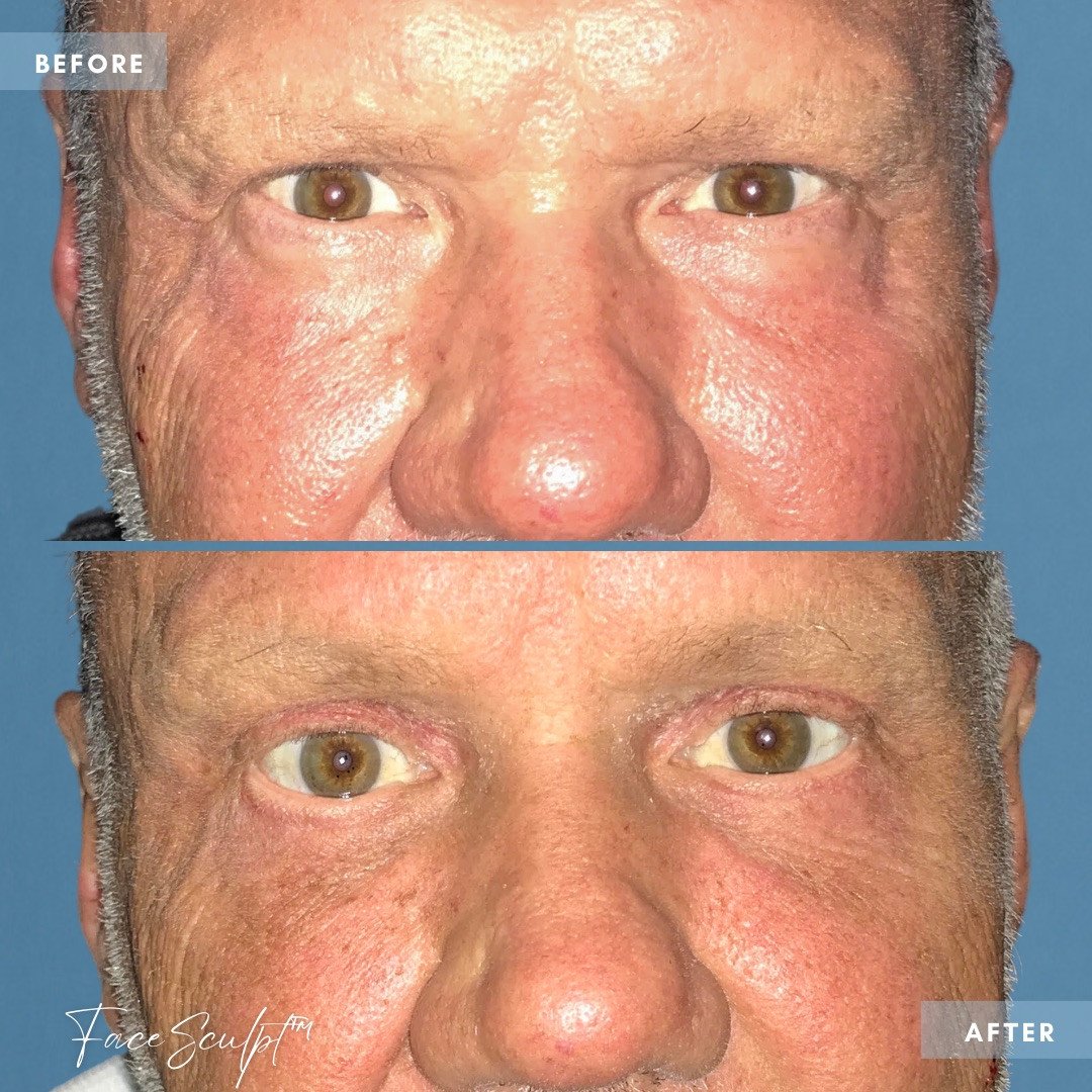 coronal-brow-lift-surgery-dr-francine-vagotis-before-after-chicago-facesculpt