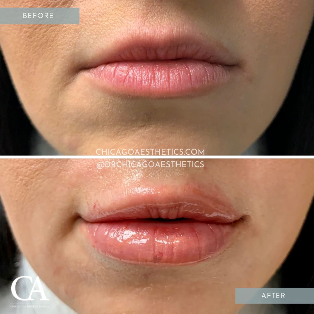 #108 Lip Injections Before After Chicago Aesthetics