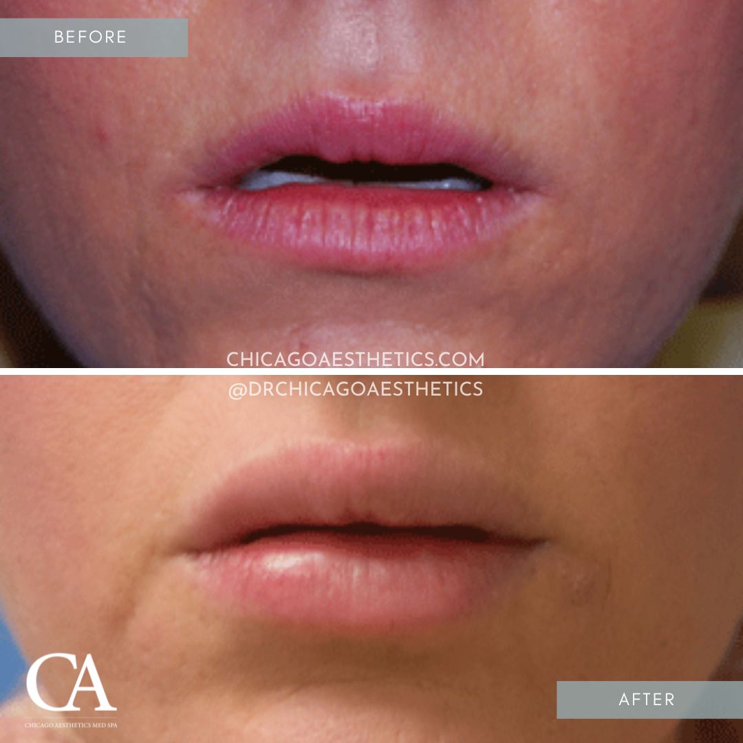 A woman's lips transformed by lip injections.