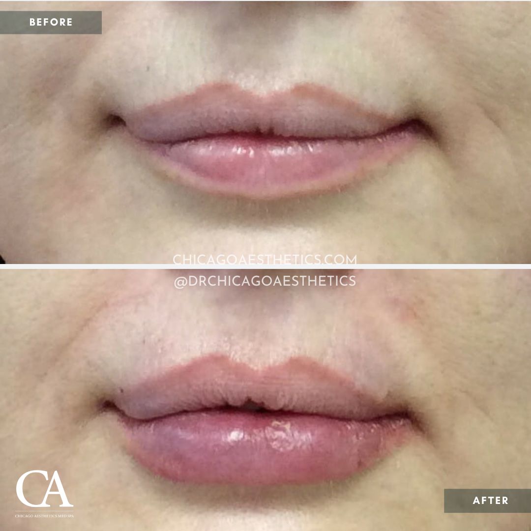#187 Lip Filler Before After Juvederm Ultra Plus - AT