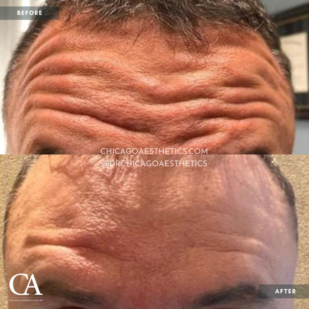 #302 Botox Male Before After Chicago Aesthetics