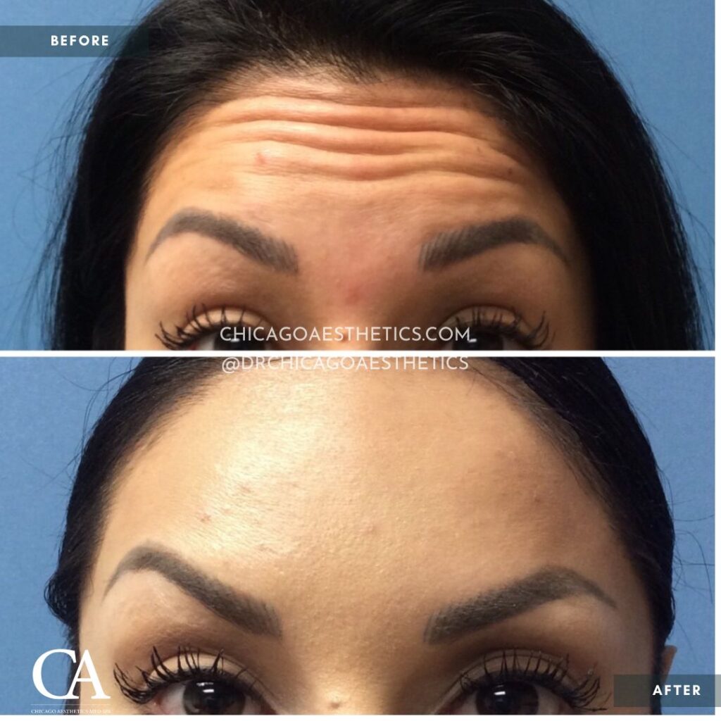#303 Botox Before After Chicago Aesthetics