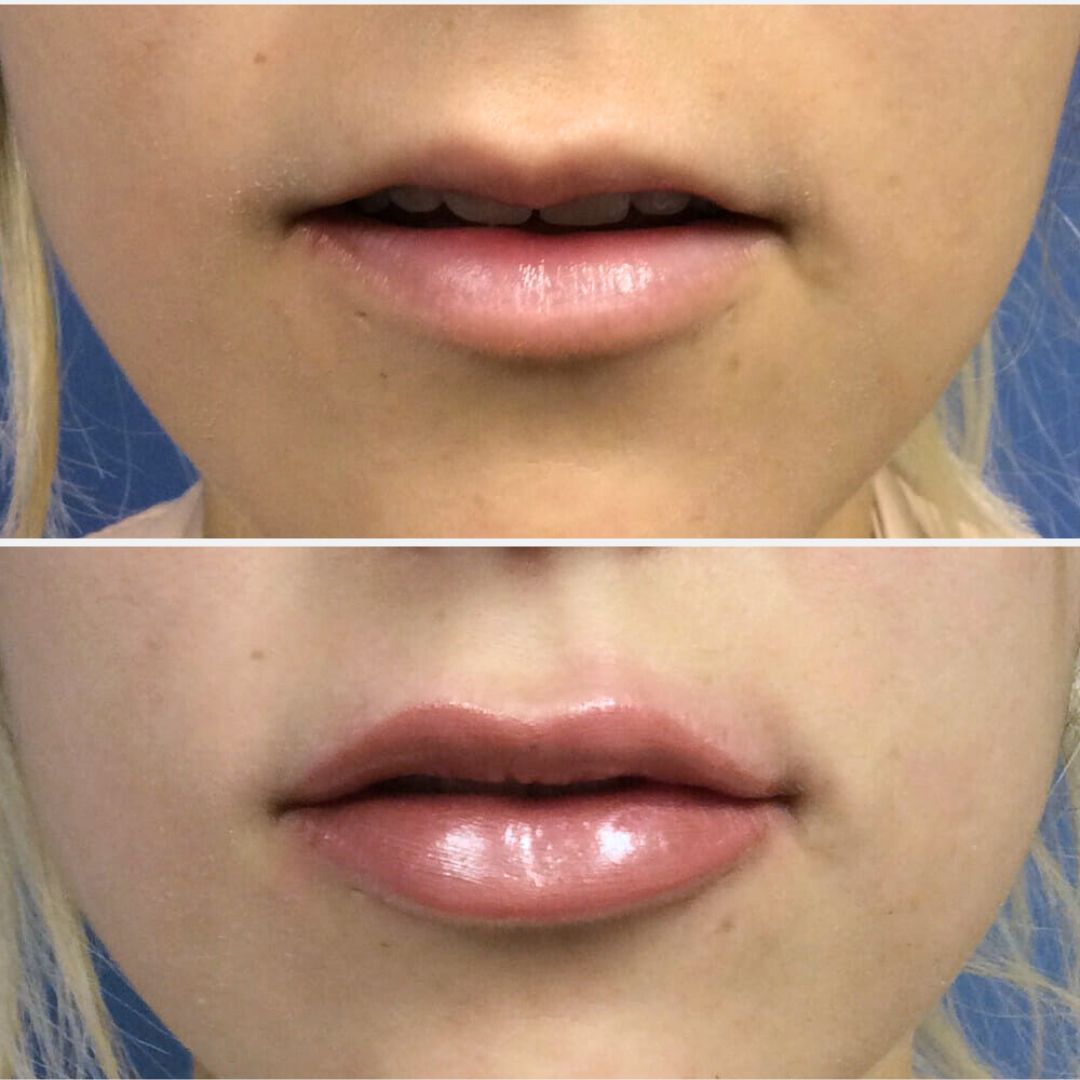 #314 Lip Filler Before After Lip 1 ml of Juvederm Ultra Plus - AT