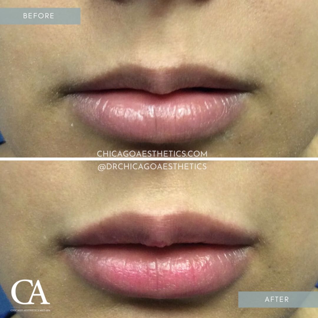 #108 Lip Injections Before After Chicago Aesthetics