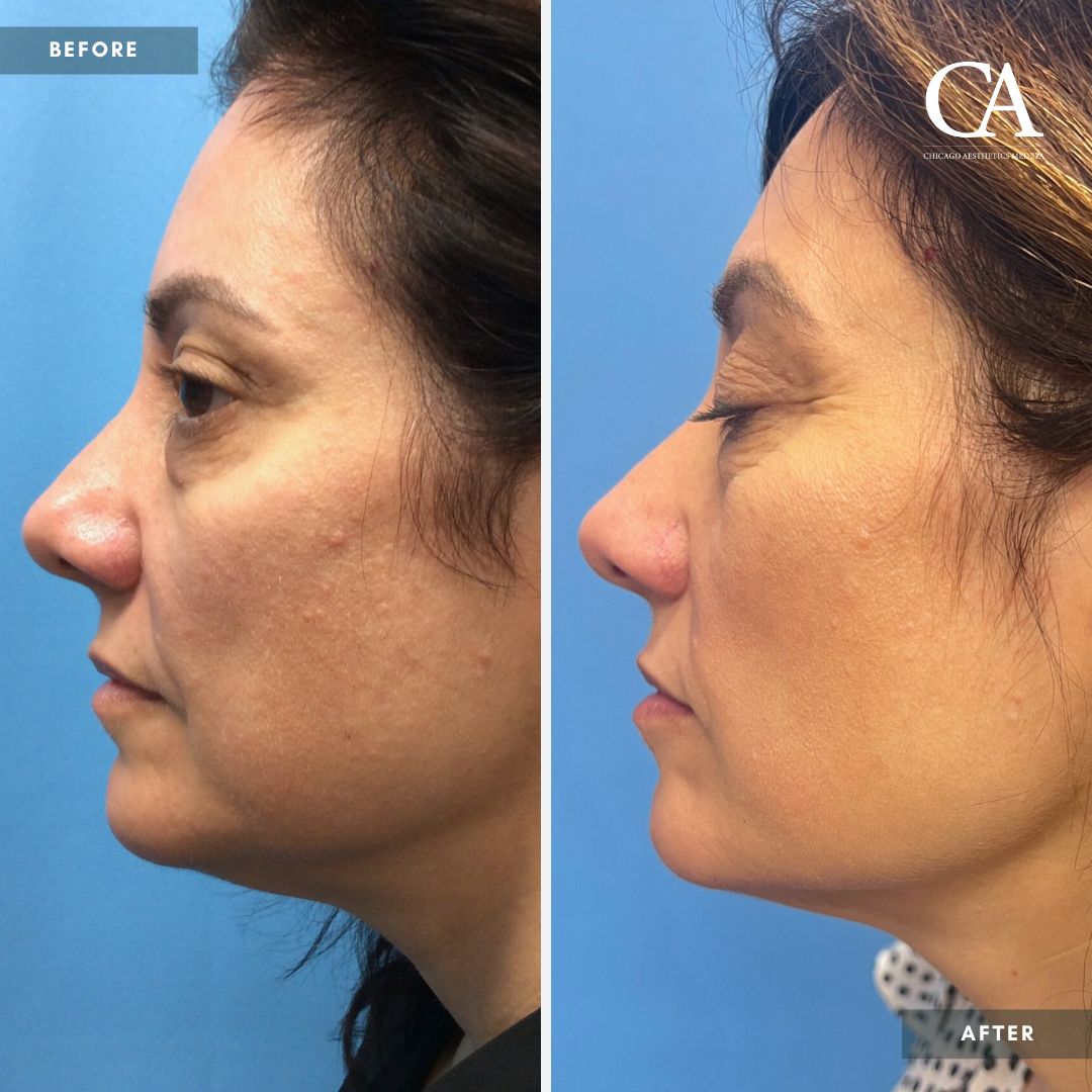 A woman's face before and after rhinoplasty, featuring lip injections.