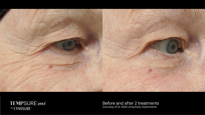 A woman's eyes are shown before and after skin tightening treatment.