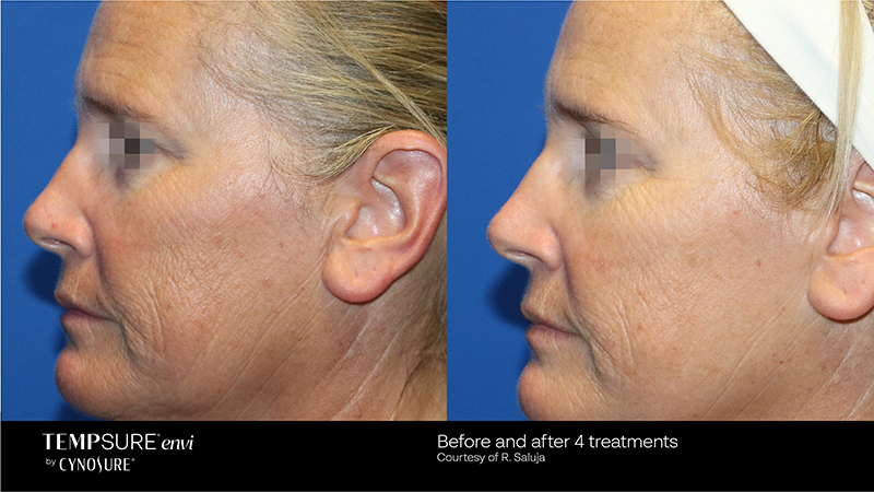 Before and after photos showcasing a woman's rhinoplasty transformation with enhanced skin tightening.