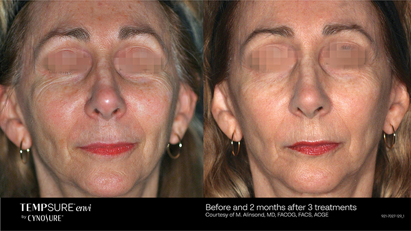 A woman's face transformation with skin tightening treatment.
