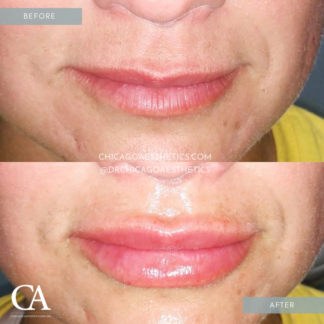 #128 Lip Filler Injections Before After Chicago Aesthetics