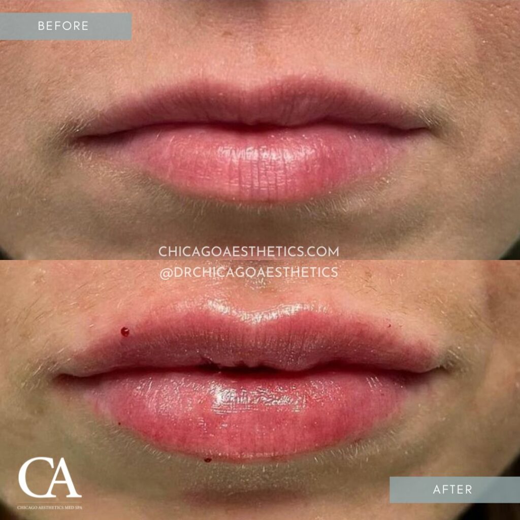 #206 Lip Filler Injections Before After Chicago Aesthetics