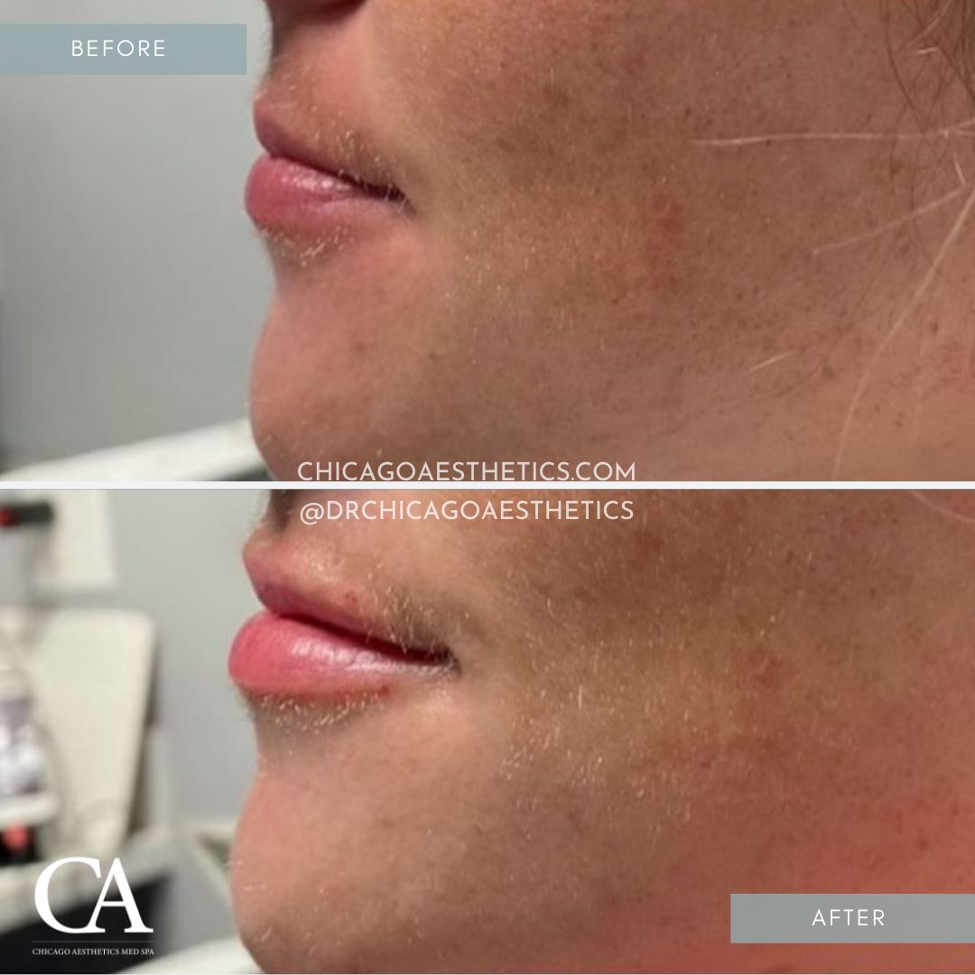 #305 Lip Filler Injections Before After Chicago Aesthetics
