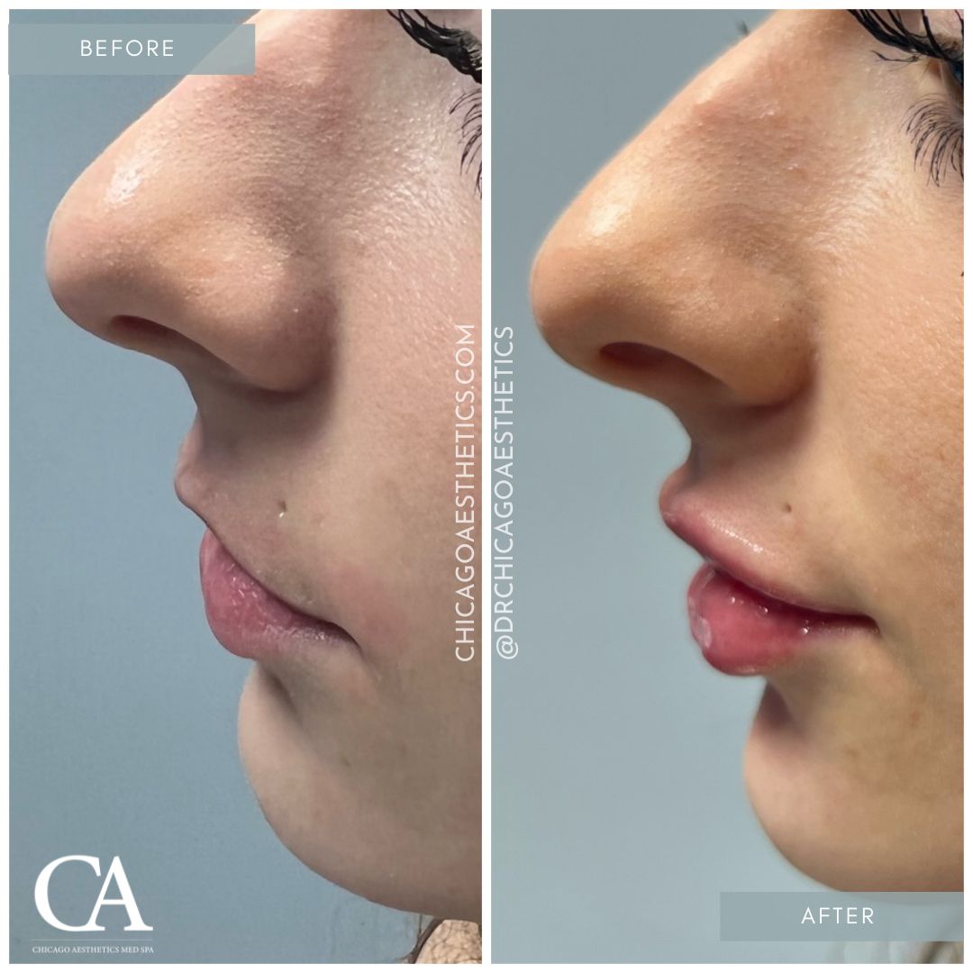 #308 Lip Filler Injections Before After Chicago Aesthetics