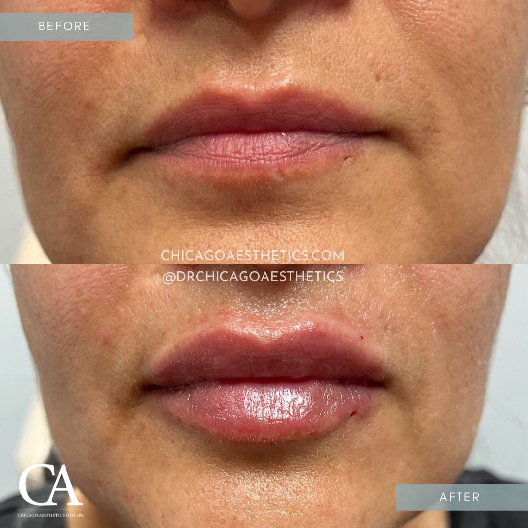 #309 Lip Filler Injections Before After Chicago Aesthetics
