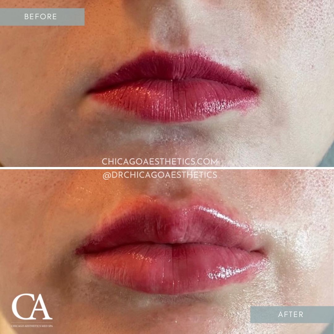 #314 Lip Filler Injections Before After Chicago Aesthetics