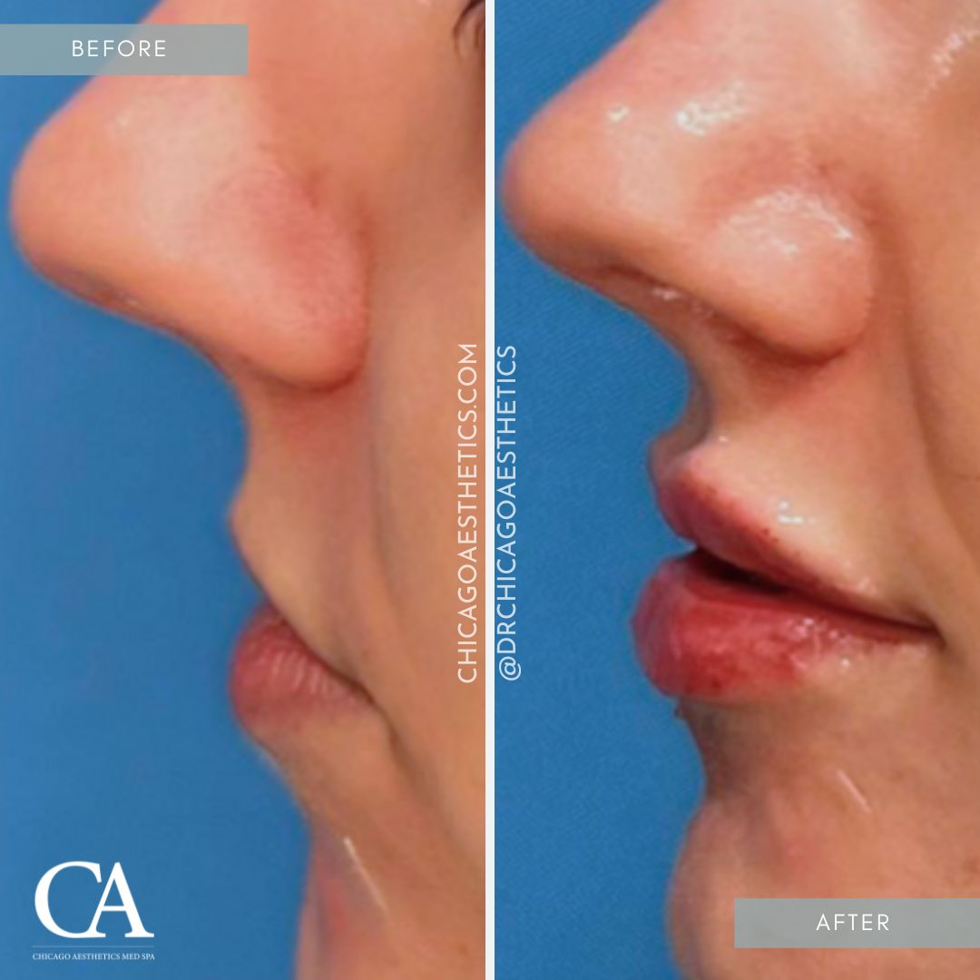 #317 Lip Filler Injections Before After Chicago Aesthetics